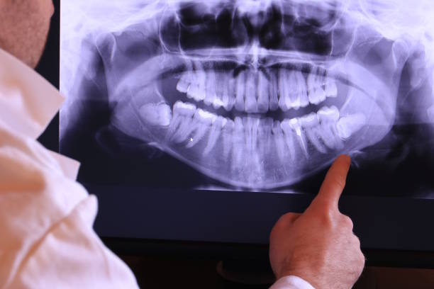 Best Emergency Treatment for Dental Infections or Abscesses in San Juan Pistrano, CA