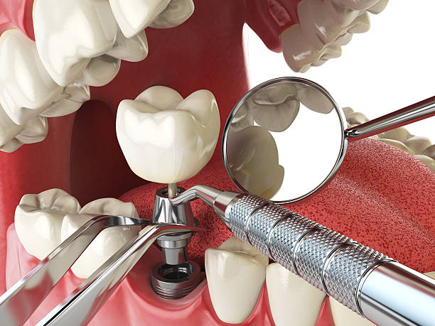 Best Same-Day Emergency Dental Services in San Juan Pistrano, CA